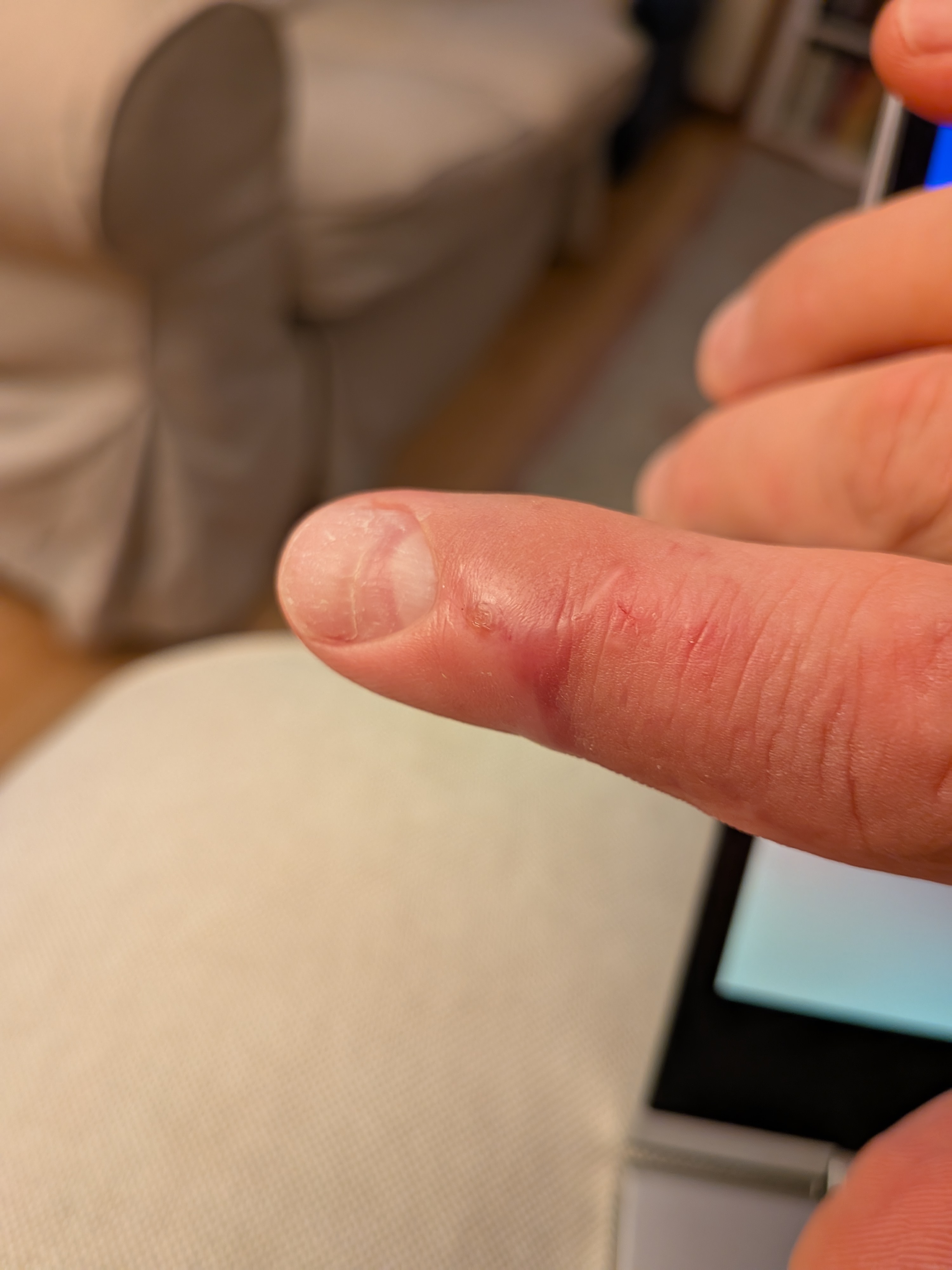 A few months later, pretty much normal finger