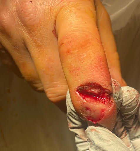 The end result of the plastic surgery residents in the ER.  Note the visible bone.