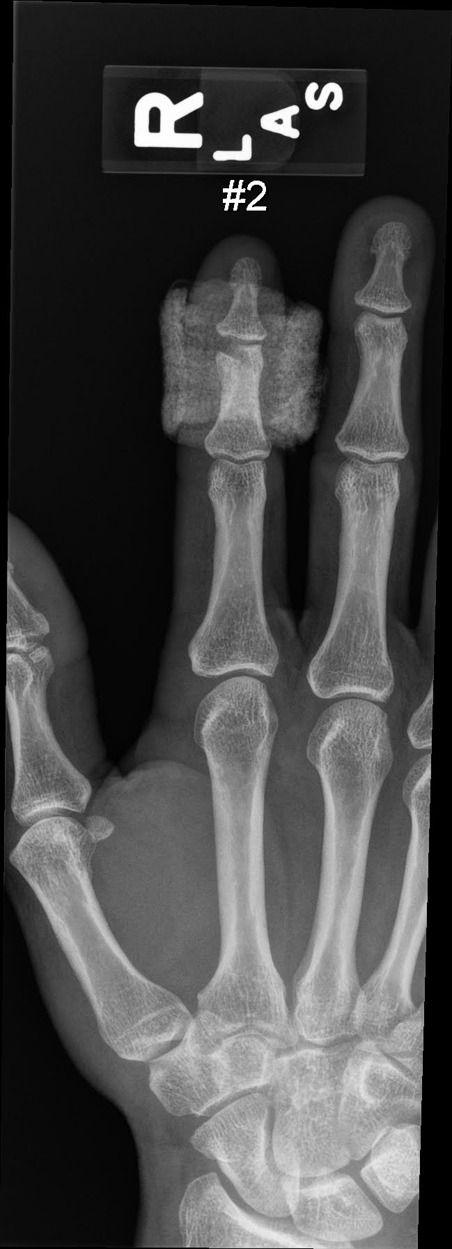 Xray showing bone that was ground away