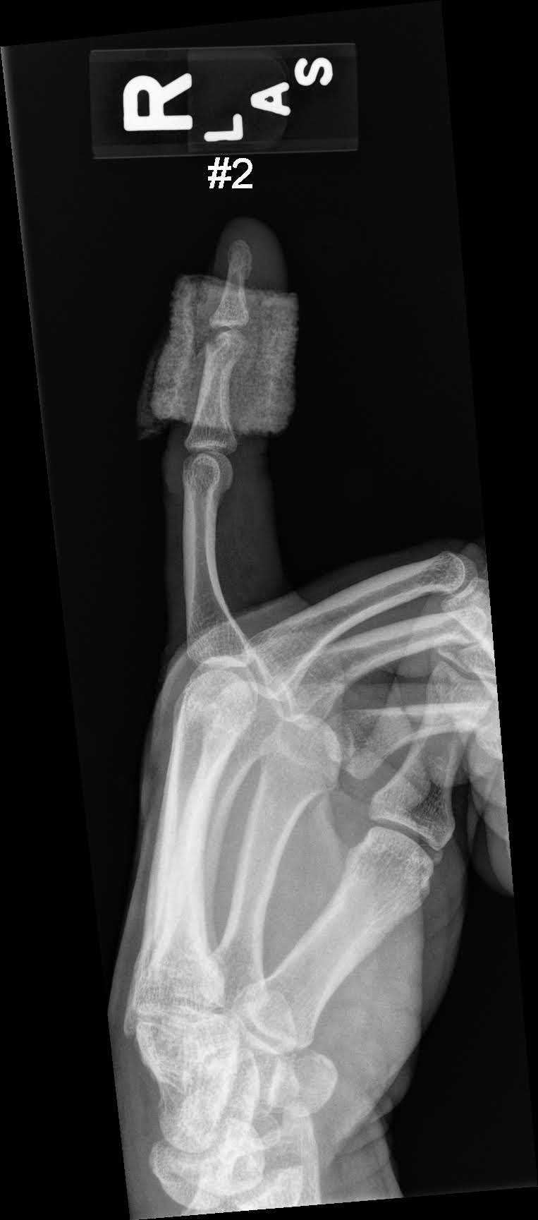 Xray showing bone that was ground away